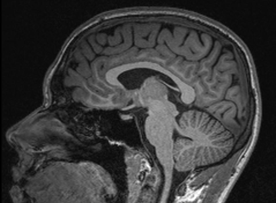 MRI of the human brain
